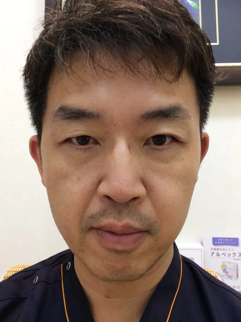 ヒアルロン酸＋ベビーコラーゲンのダブルフィラー