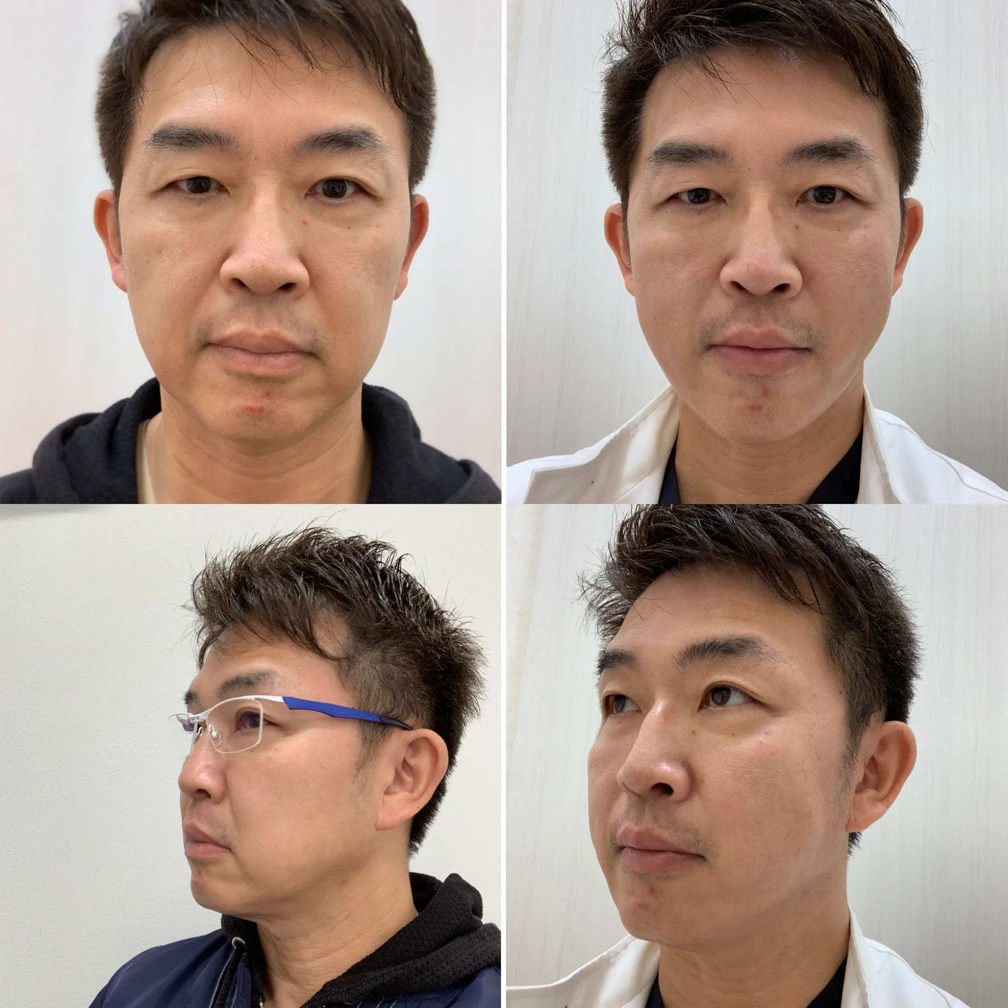 50歳代のリフトアップは？！